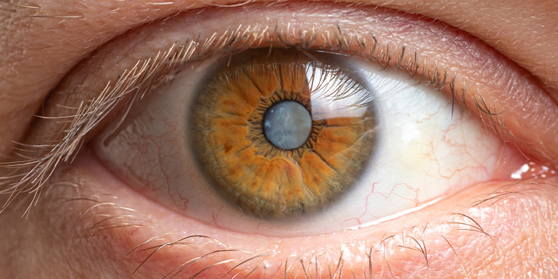 The Best Way To Avoid Developing Cataracts