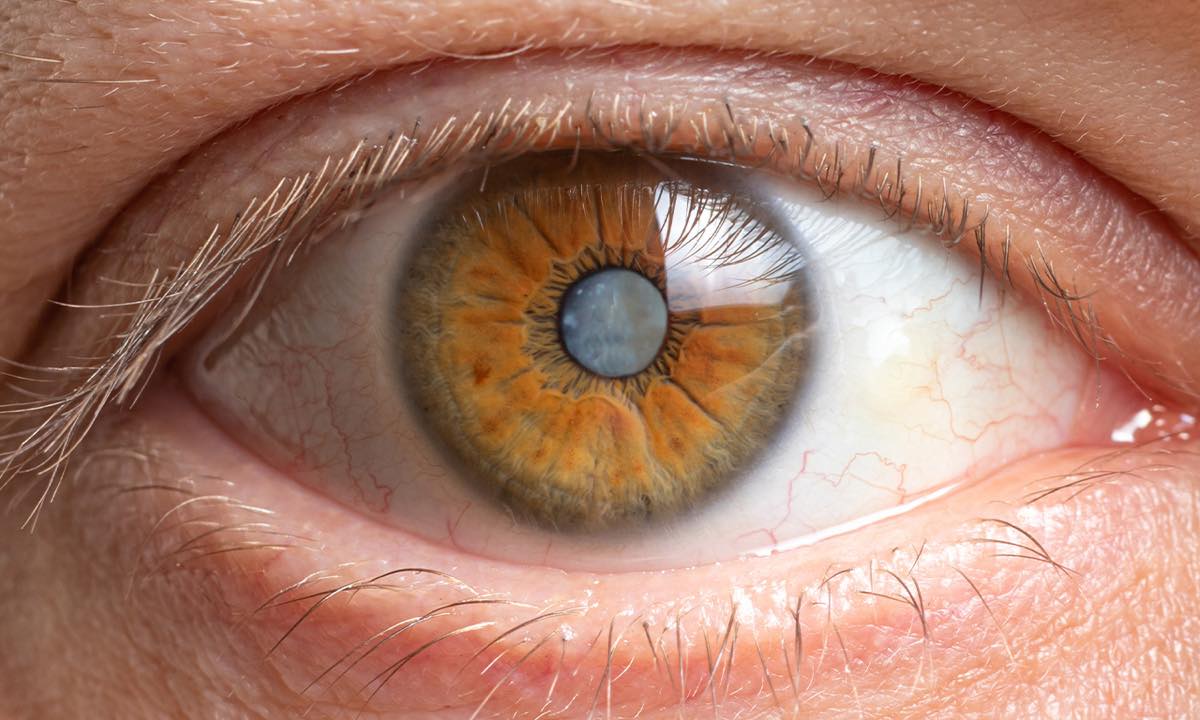 The Best Way To Avoid Developing Cataracts