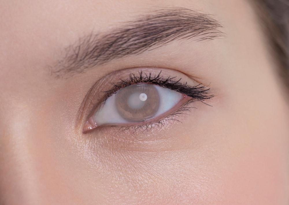 What Causes Cataracts?