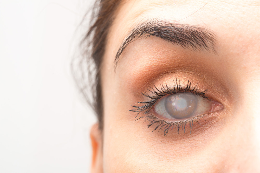 A Walkthrough of Laser Cataract Surgery