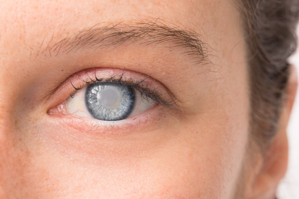 Congenital Cataracts: Early Diagnosis is the Key