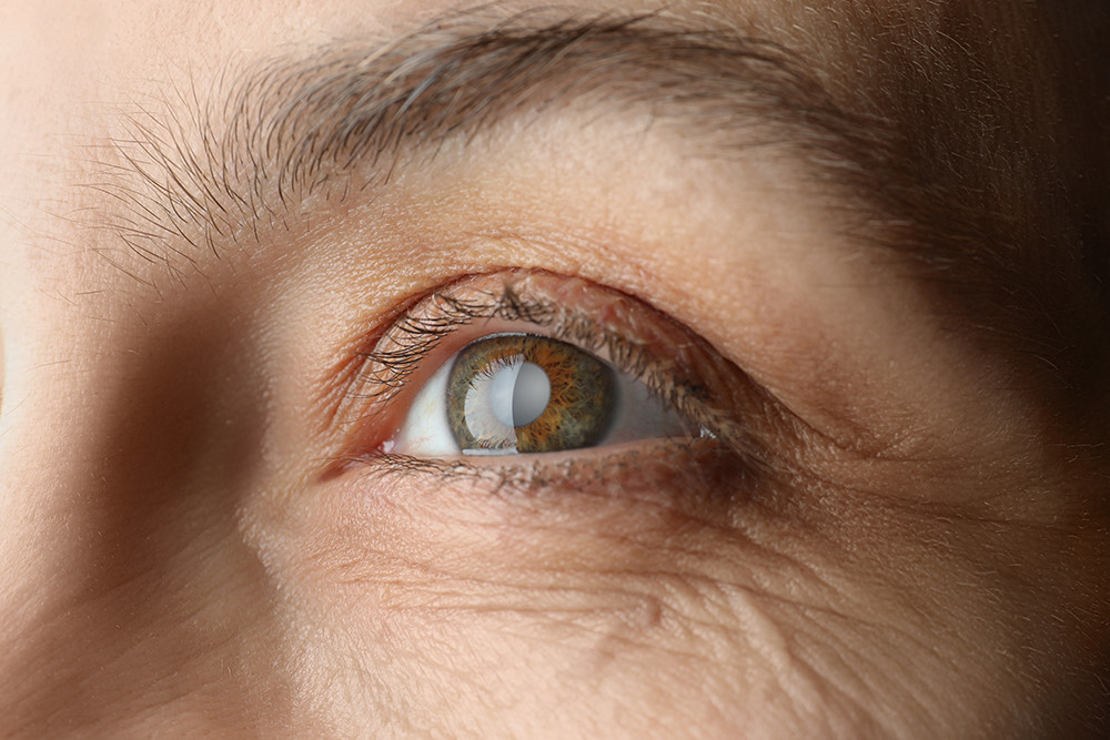 What Does it Mean for Cataracts to be Ripe