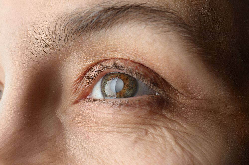 What is Posterior Subcapsular Cataract?