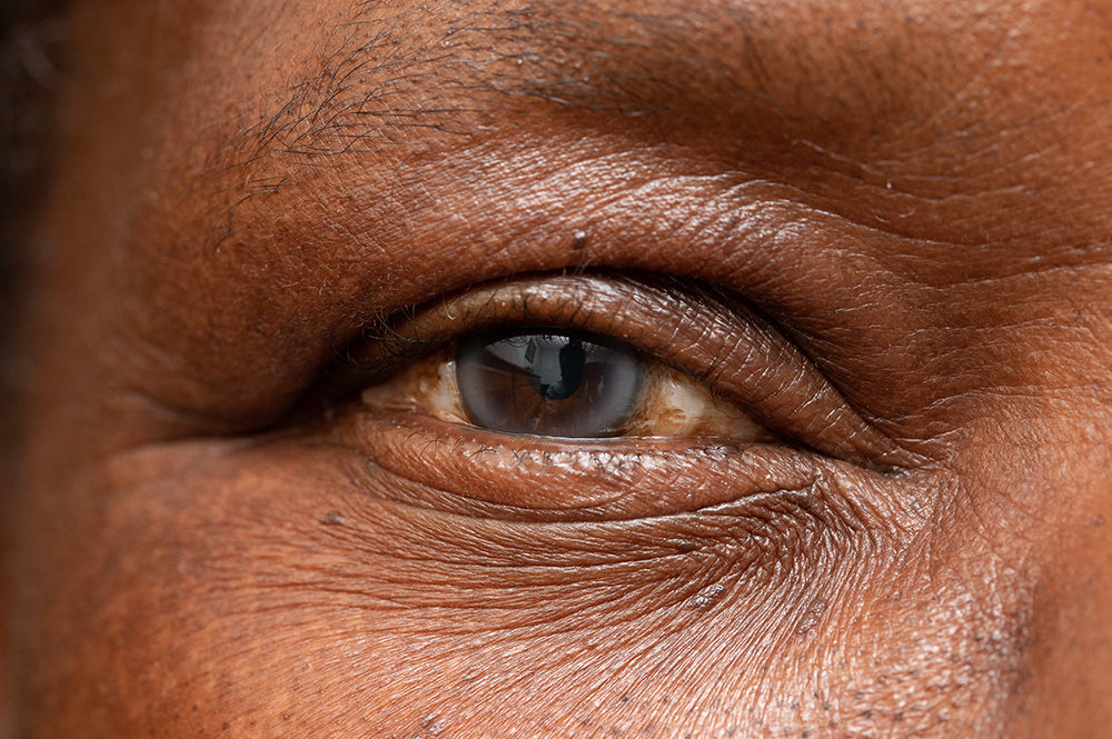 Why Are My Eyes Cloudy?