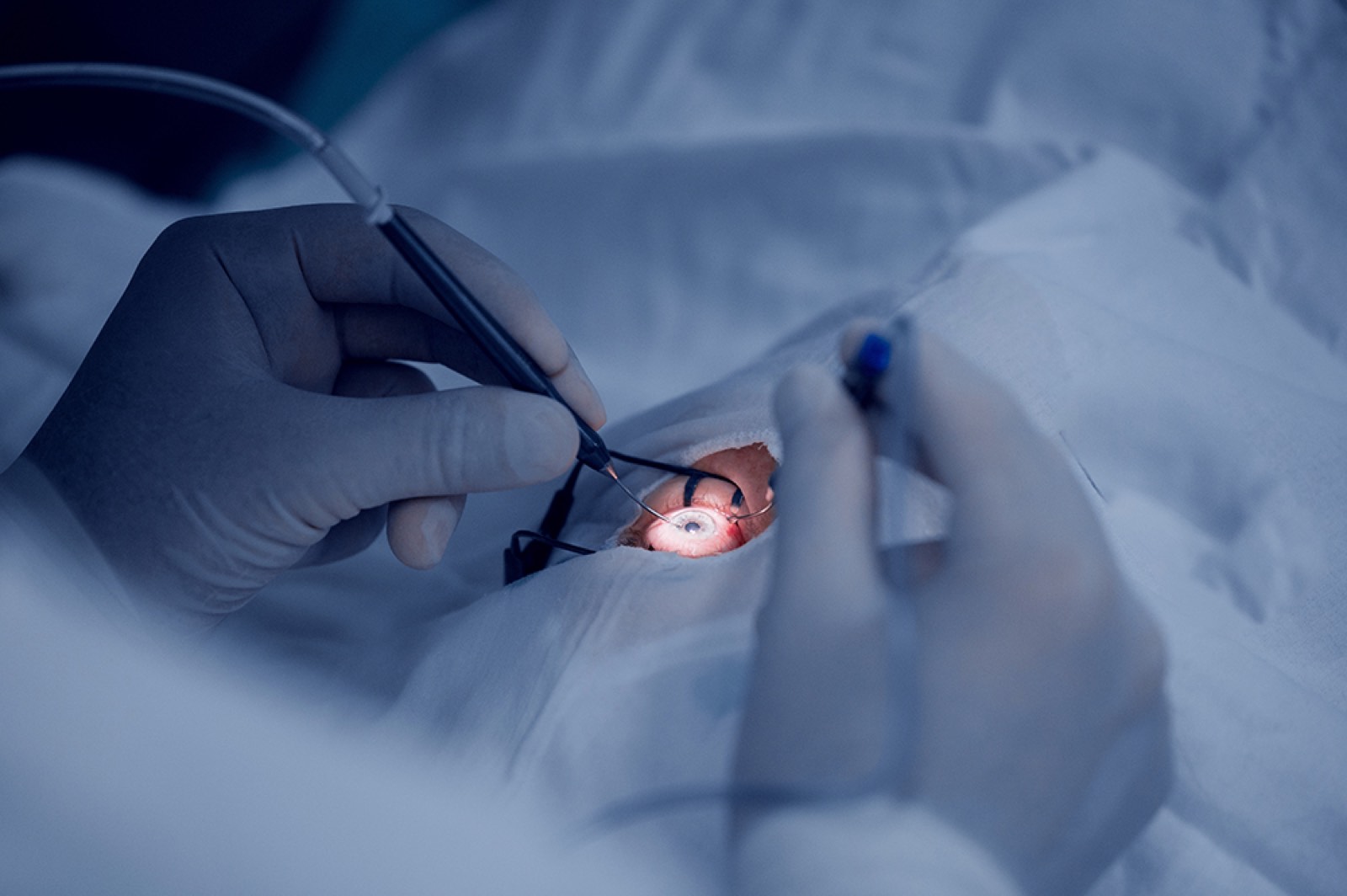 Traditional Cataract Surgery vs. Laser-Assisted Cataract Surgery