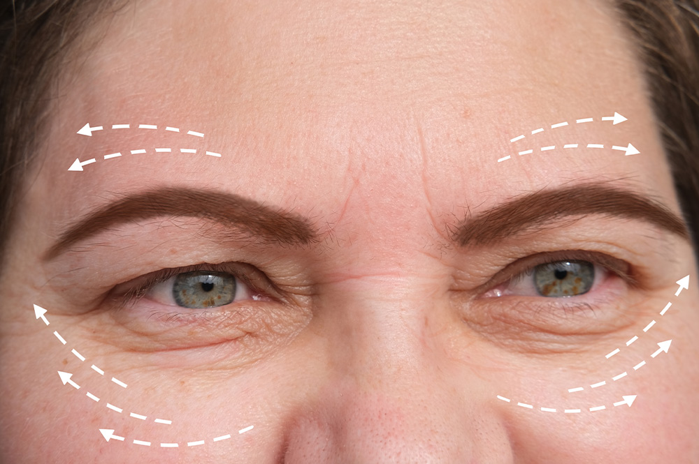 Eyelid Drooping After Cataract Surgery