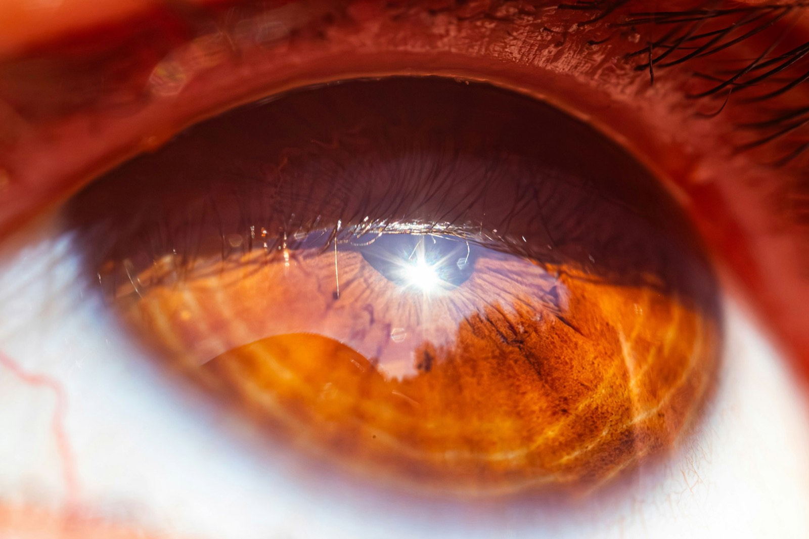 Why More Patients Are Choosing Laser-Assisted Cataract Surgery