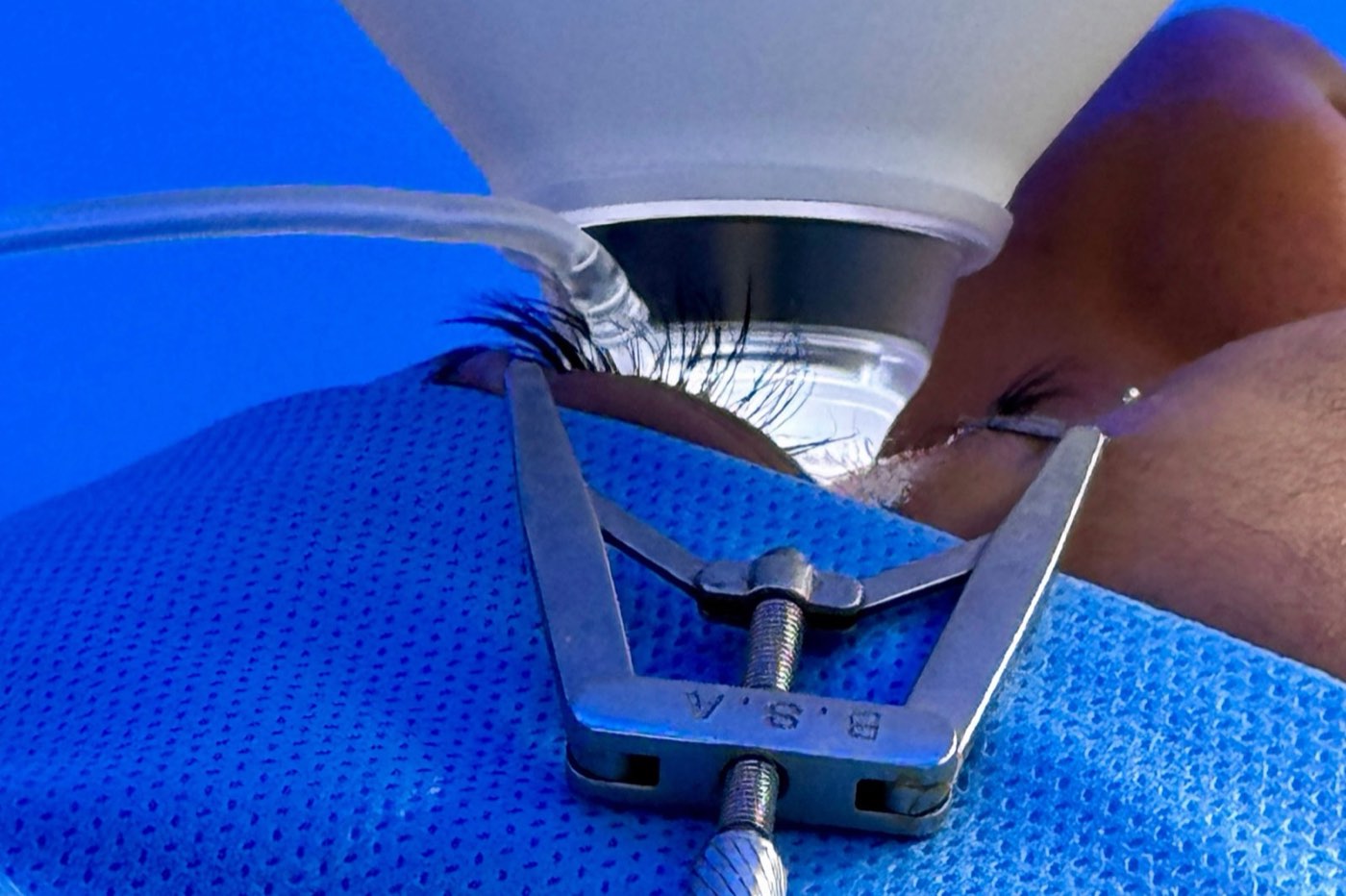 What Is the Femtosecond Laser in Cataract Surgery?