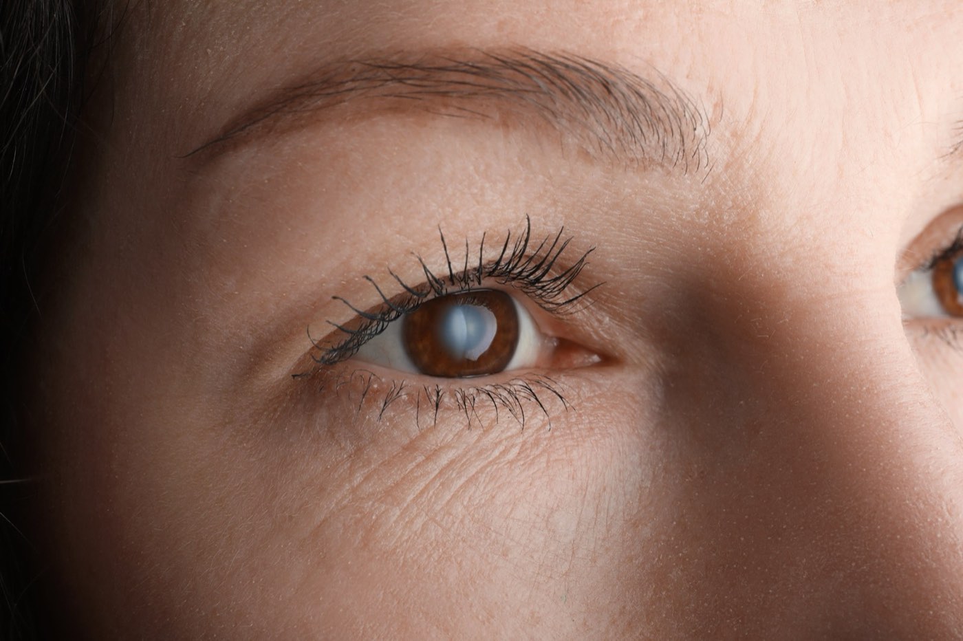 What Is a Secondary Cataract—And How Is It Treated?