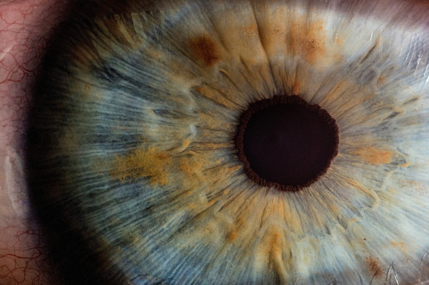 How to Choose the Right Intraocular Lens (IOL) for Cataract Surgery